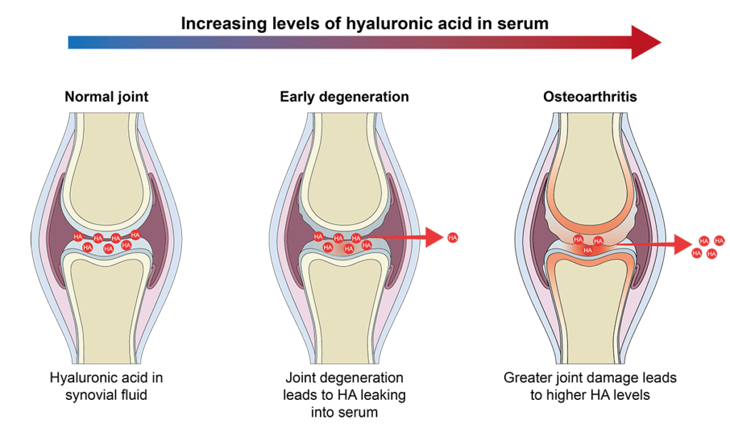 Diagram showing the progression of joint damage with hyaluronic acid leaking out of the joint as disease progresses.  Left is normal joint, releasing no hyaluronic acid to the right which is advanced disease releasing significant hyaluronic acid.